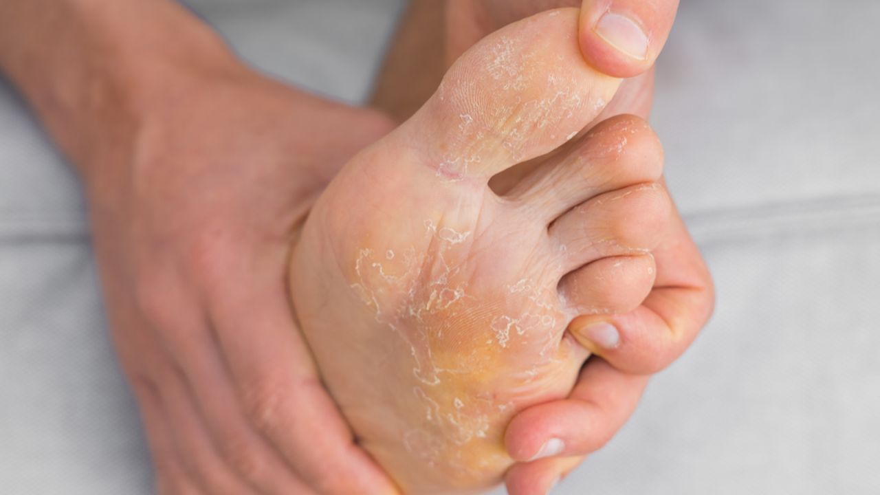 Tutkijat ovat löytäneet mahdollisen tavan torjua sairaaloissa potilaita vaivaavaa sieni-infektiota.