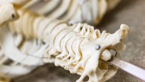 Selkärangan rappeuttavat sairaudet: miten ne tunnistaa ja milloin on syytä toimia.