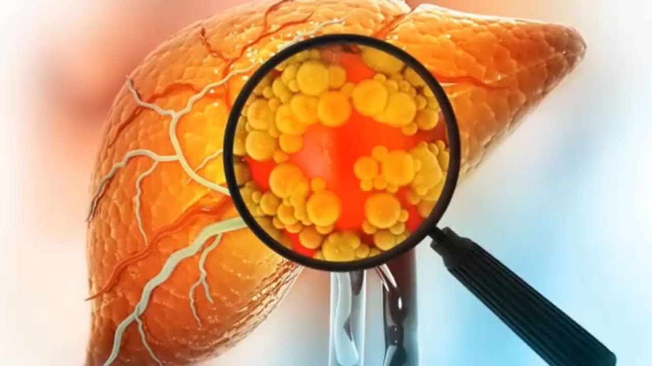 He varoittavat, että rasvainen ruokavalio muuttaa maksan solujen rakennetta ja lisää syövän riskiä.