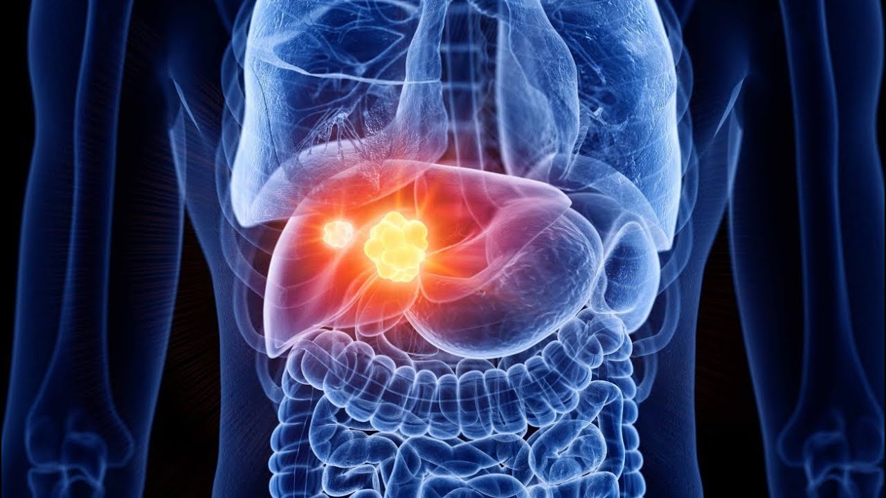 He varoittavat, että rasvainen ruokavalio muuttaa maksan solujen rakennetta ja lisää syövän riskiä.