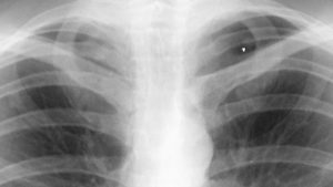 Mitä ovat keuhkoknöt ja milloin ne voivat aiheuttaa huolta?