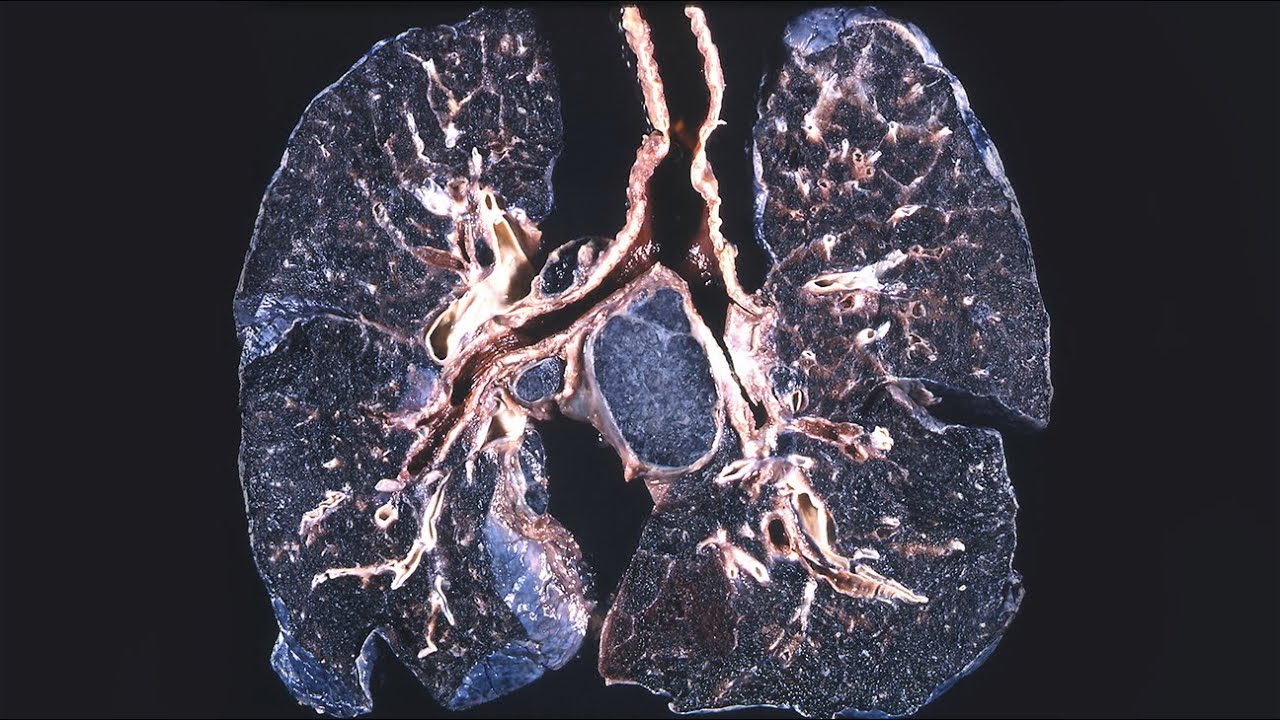Mitä ovat keuhkoknöt ja milloin ne voivat aiheuttaa huolta?