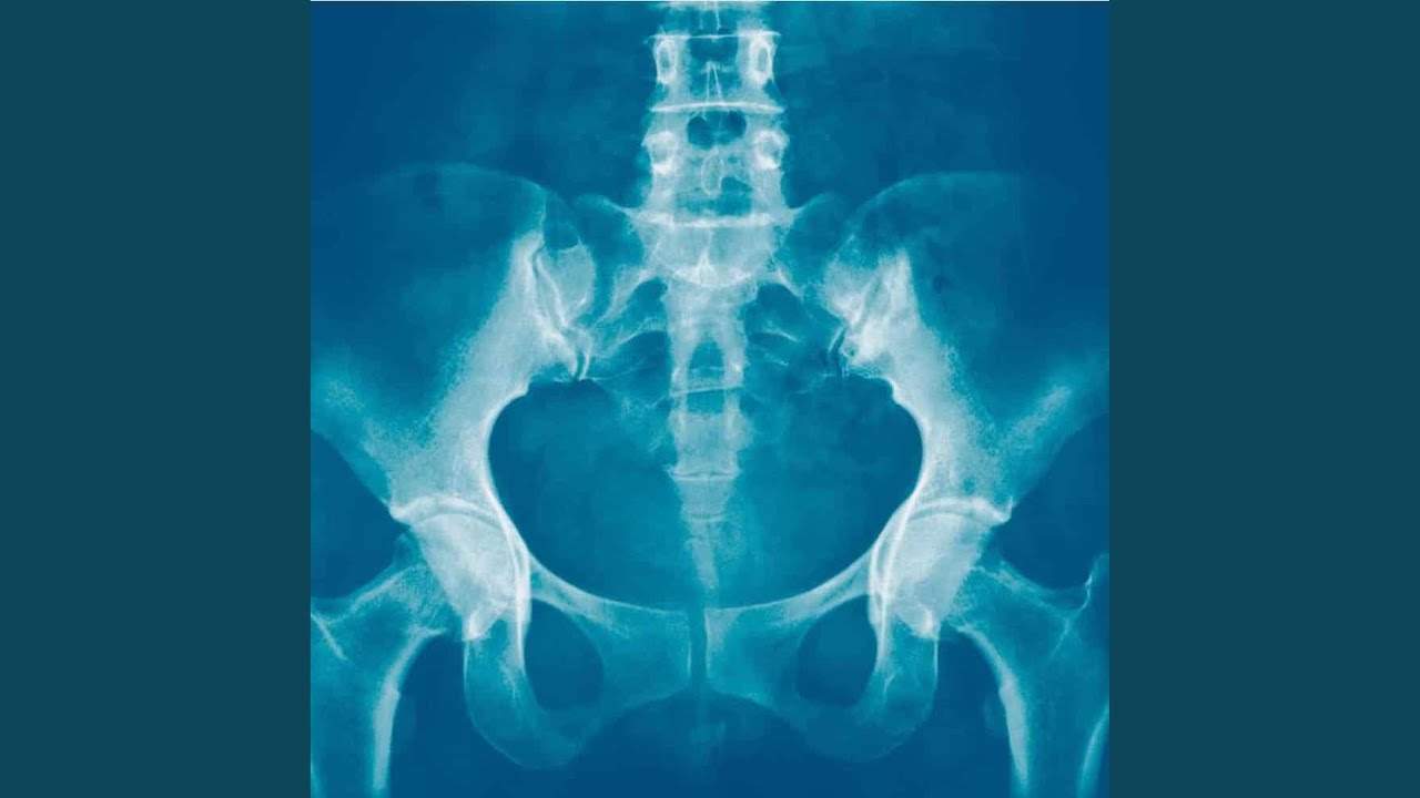 Mikä on Salvador Illan sairastama bakteerin aiheuttama pubisymfysitis?